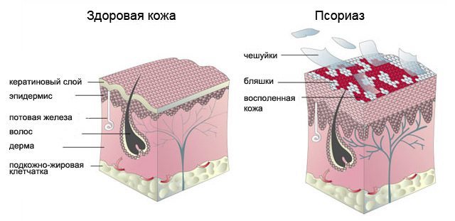 В России одобрен инновационный препарат для лечения бляшечного псориаза средней и тяжелой степени